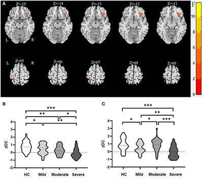 Abnormal Degree Centrality in White Matter Hyperintensities: A Resting-State Functional Magnetic Resonance Imaging Study